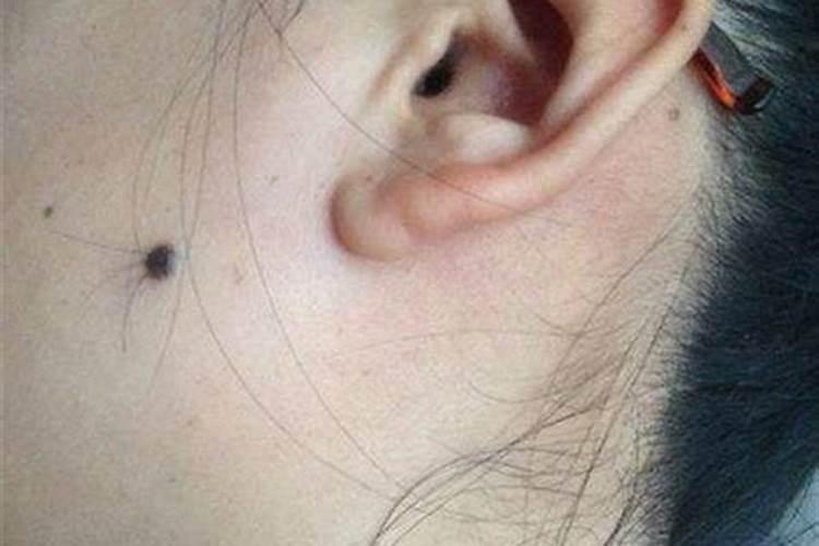 脖子上带毛的黑痣有什么运势？