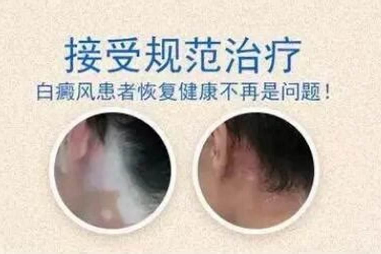 冬至白癜风患者注意事项