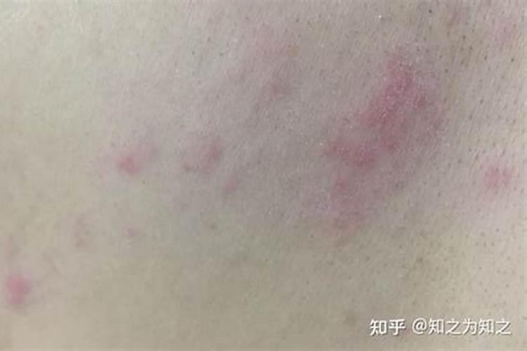 本命年容易长带状疱疹吗？