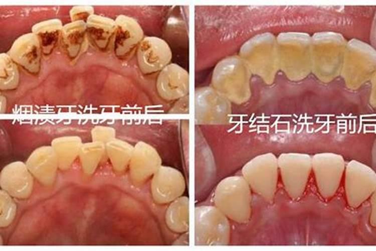 洗牙可以去破太岁吗？