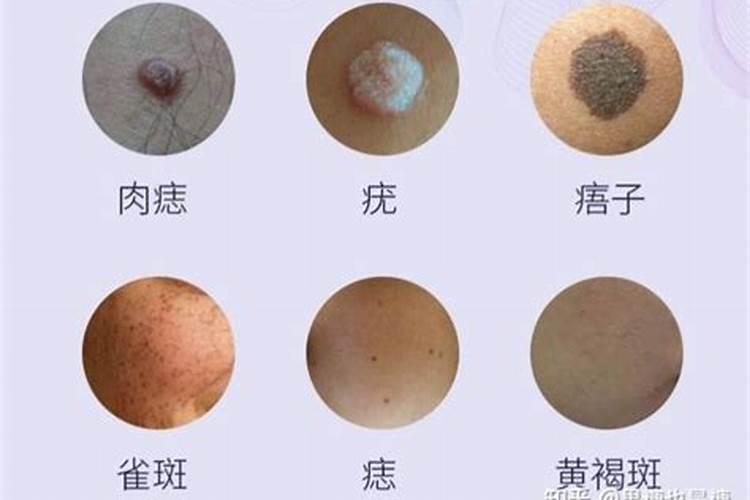童子命身上的痣可以拿掉