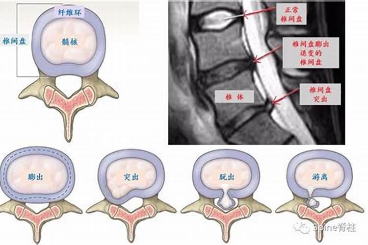腰椎间盘突出婚姻也不顺