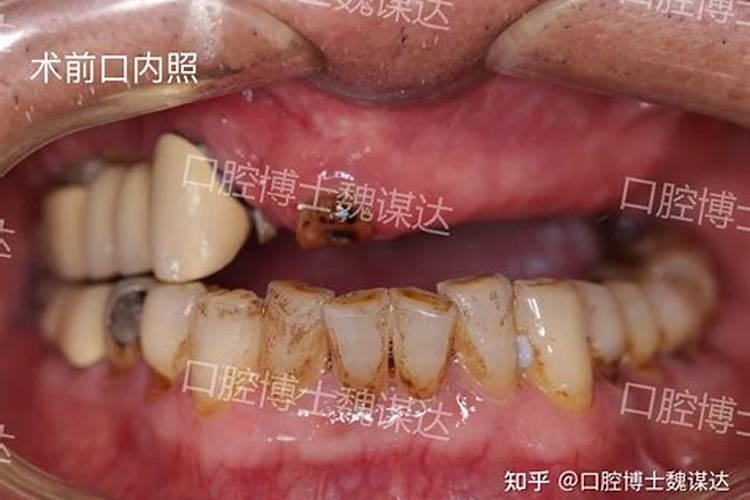 梦到老人的牙掉了一半怎么办？