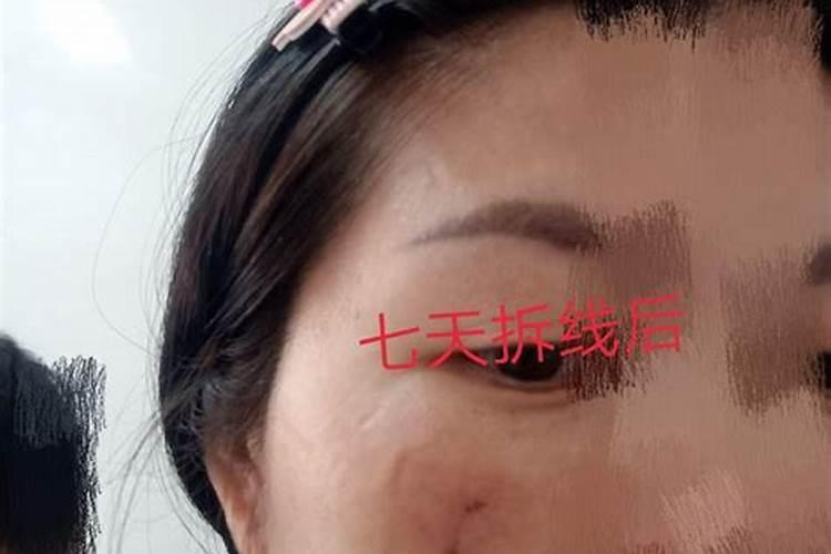 切除痣后运势改变吗？