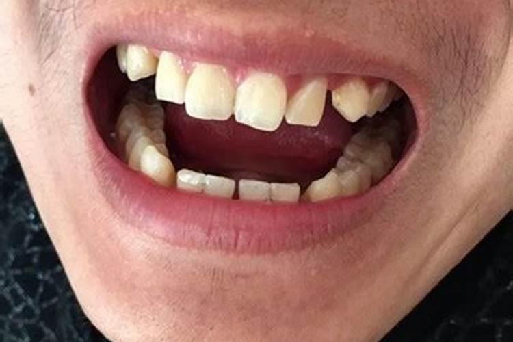 梦见掉牙怎么回事？