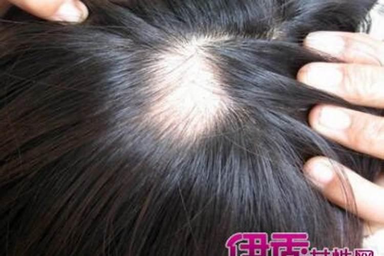 老年人梦见自己掉头发