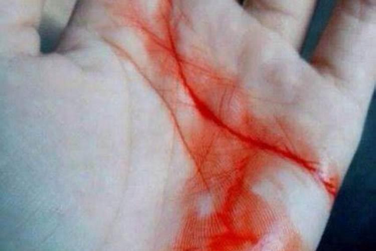 梦见亲人受伤流了很多血？